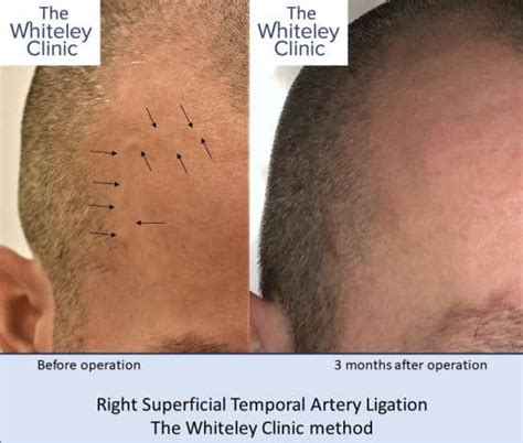 Removal bulging superficial temporal arteries