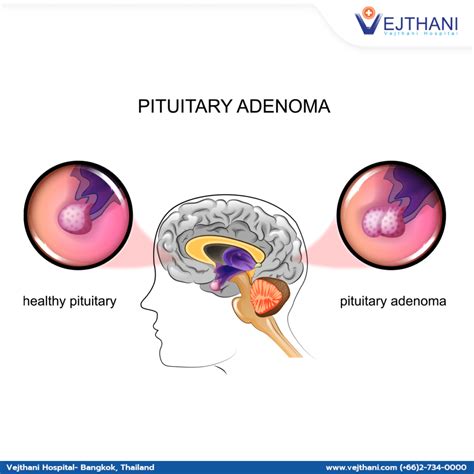 "Understanding Pituitary Adenomas: Overview of Symptoms, Diagnosis, and Treatment Options ...