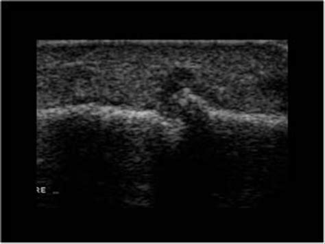 Musculoskeletal Joints and Tendons | 6.8 Foot : Case 6.8.9 Gout | Ultrasound Cases