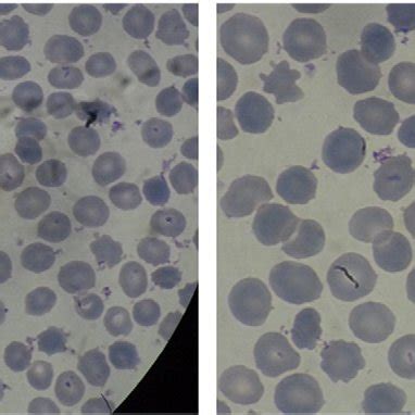 Acanthocytosis in peripheral blood. The smear shows frequent ...