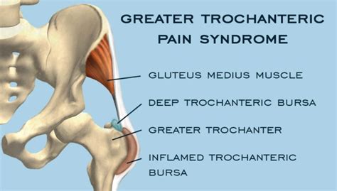 Greater Trochanter