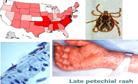 Rickettsial Infections Flashcards by ProProfs