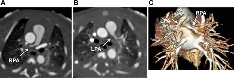 Figure 1 from Peripheral pulmonary artery stenosis: an unusual case and ...