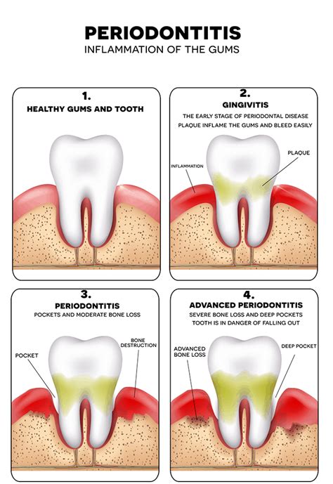 Caldwell, Bills, Petrilli & West -Periodontal Gum Treatment