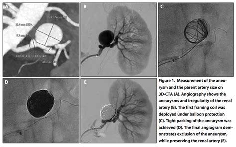 Renal Artery Function - Renal artery stenosis and Renal artery aneurysm