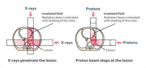 What is Proton Therapy? | Aizawa Hospital