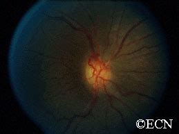 Optic Nerve Sheath Meningioma » New York Eye Cancer Center