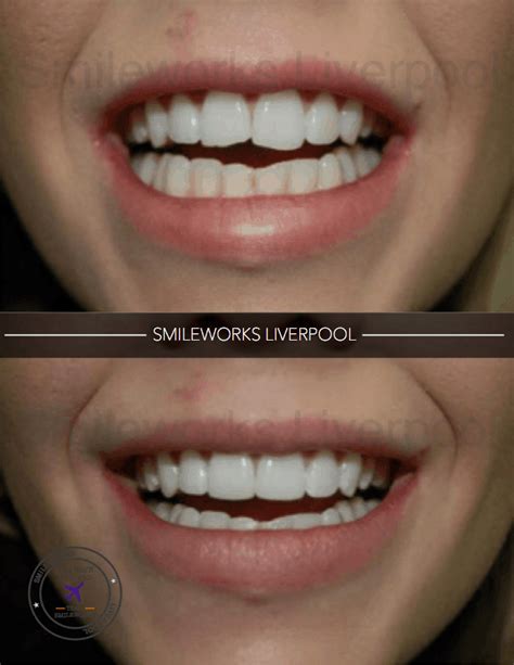 Composite Veneers: Unbiased professional review for 2024