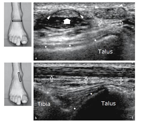 Ultrasound of the Musculoskeletal System - Chapter #16: Ankle - NYSORA | NYSORA