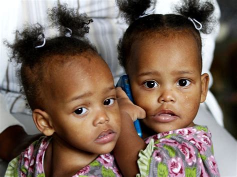 Conjoined twins Maria & Teresa Tapia: Before and after - Photo 1 - CBS News