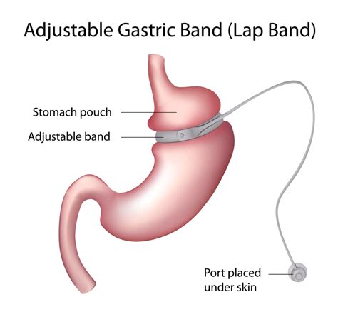 Lap Band | Brisbane Weight Loss Surgery