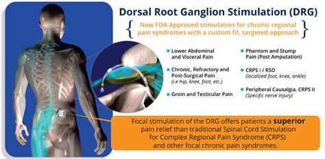 Dorsal Root Ganglion Stimulator - Dr. Mikiko Murakami