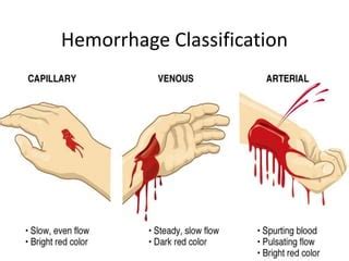 External Bleeding Treatment