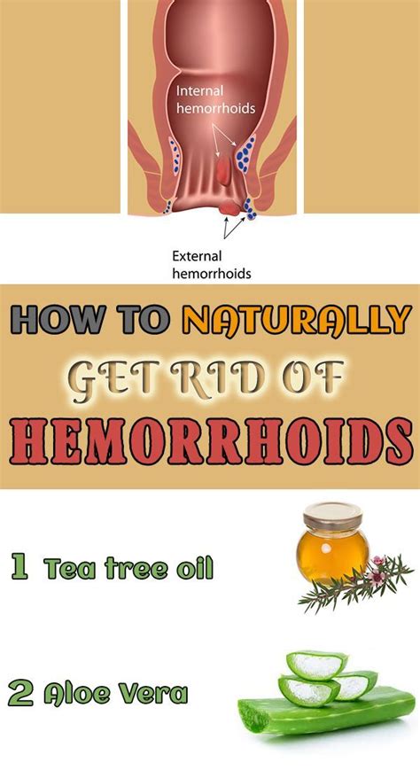 Pin on Hemorrhoids