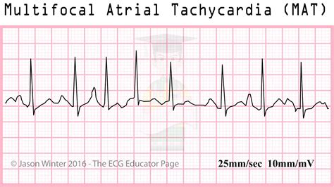 ECG Educator Blog : Atrial Rhythms