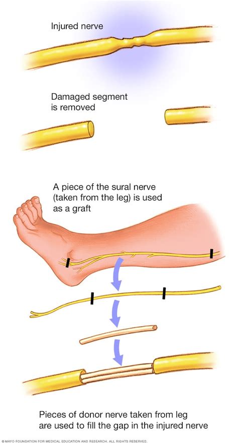 Peripheral nerve graft - Mayo Clinic