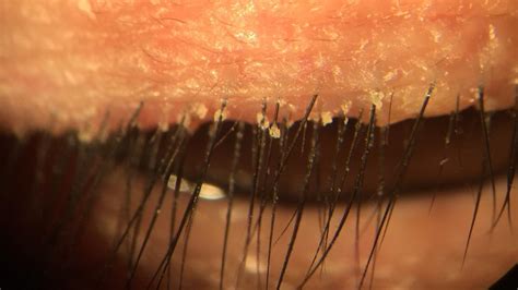 Have You Though about Creepy Eyelid Bugs? | Eyecare Plus
