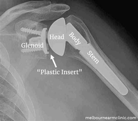 A Guide to Reverse Shoulder Replacement Surgery & Recovery