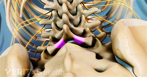 Lumbar Laminectomy Surgery Video