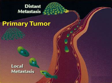 metastasis - Oncology Photo (6590384) - Fanpop