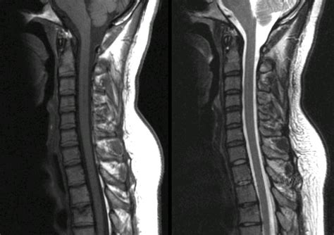 Normal Sagittal Cervical MRI