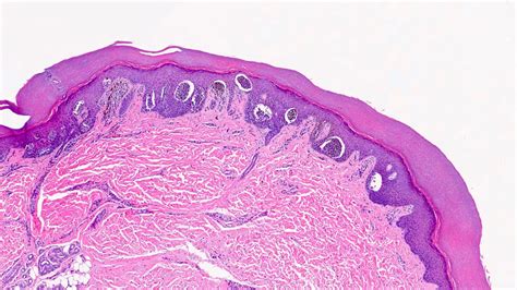 Pathology Outlines - Acral nevus