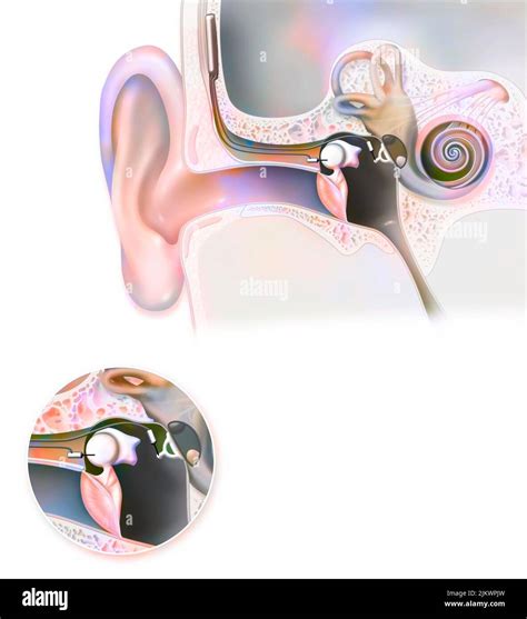 Middle ear implant hi-res stock photography and images - Alamy