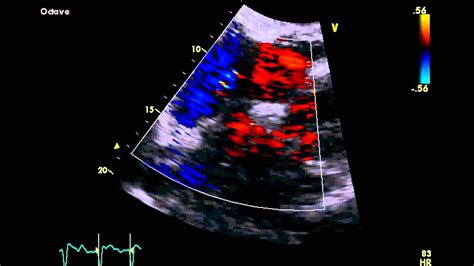 Patent Foramen Ovale - Transthoracic Echocardiogram (TTE) - YouTube