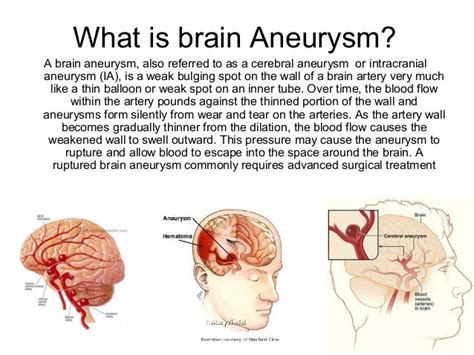 Brain aneurysm coiling