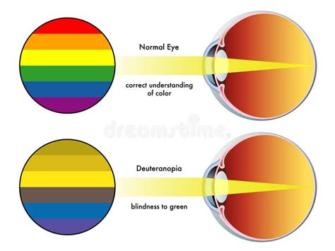 Deuteranopia stock vector. Illustration of vision, lens - 27568092