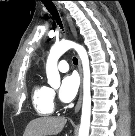 Sternal Osteomyelitis With Inflammation / CTisus.com | Case study, Inflammation, Musculoskeletal ...