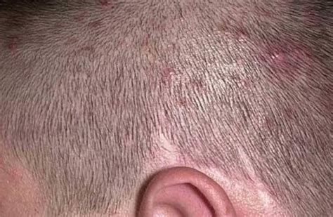 Scalp Folliculitis | Pimples on scalp, Scalp acne, Scalp acne treatment