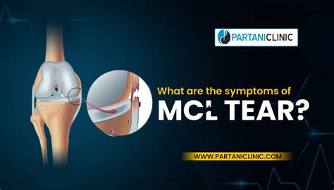 What are the Symptoms of MCL Tear? | Partani Clinic