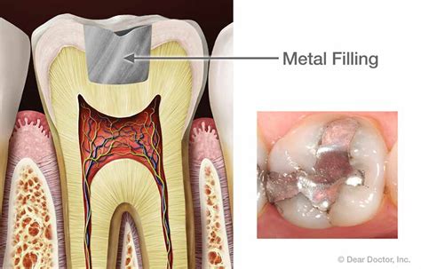 Fillings | Dr. Curtis Kaiser | College Station TX