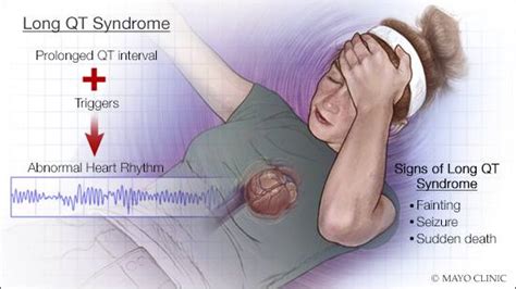 First hybrid gene therapy shows early promise in treating long QT syndrome - Mayo Clinic News ...