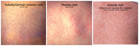 Rubella - Dr. Mansi Jariwala