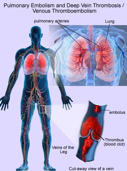 Pulmonary Embolism and Deep Vein Thrombosis / Venous Thromboembolism