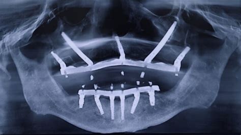 Treatment of the Severely Atrophic Arch with Zygomatic, Pterygoid, and Vomer Dental Implants ...