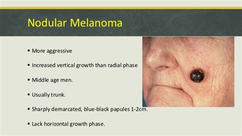 Malignant tumors of skin