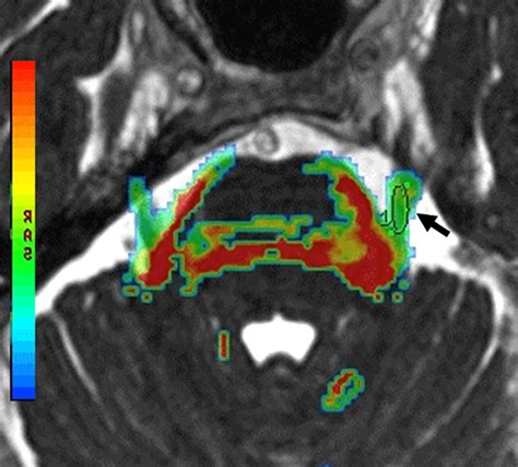 Trigeminal Neuralgia due to Neurovascular Compression: High-Spatial ...