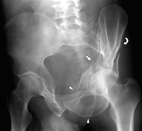 Classification of Common Acetabular Fractures: Radiographic and CT ...