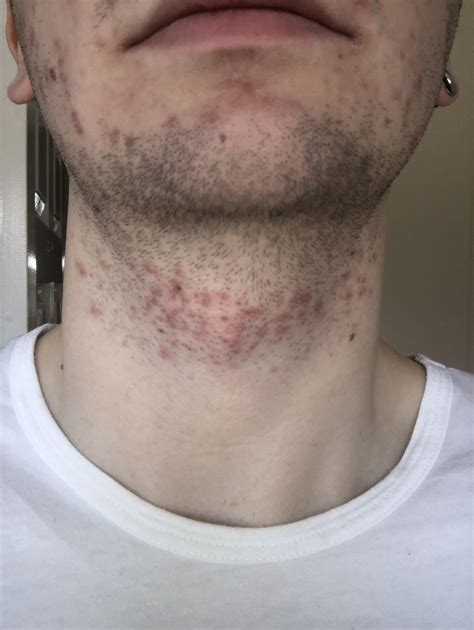 Neck Acne Shaving