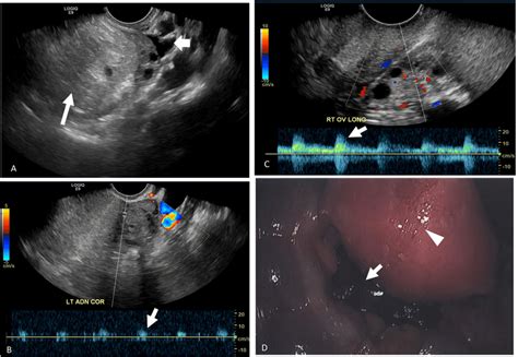 A 38-year-old female with left adnexal torsion in the presence of a... | Download Scientific Diagram