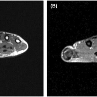 (A) T1 weighted MRI image of the left hand showing thickening of flexor ...