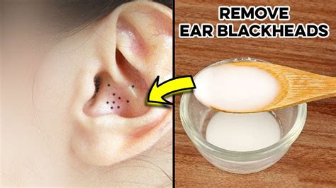 3 Best Ways for Ear Acne Blackheads Removal | How to Remove Ear ...