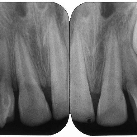 Periapical radiograph showing maxillary left lateral incisor with talon ...