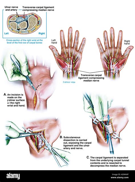 Carpal tunnel surgery hi-res stock photography and images - Alamy