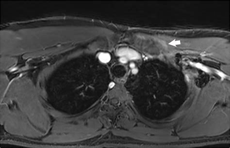 Desmoid tumor patient following surgical resection and cryoablation of ...