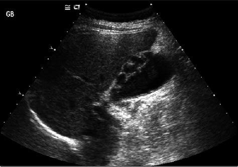 Ultrasonography showed thickened gallbladder wall with intramural... | Download Scientific Diagram