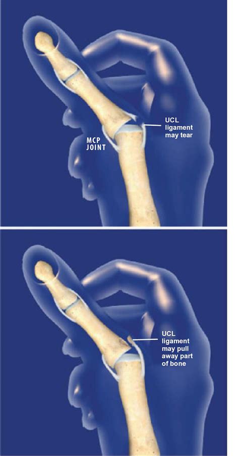 Ulnar Collateral Ligament Thumb Test